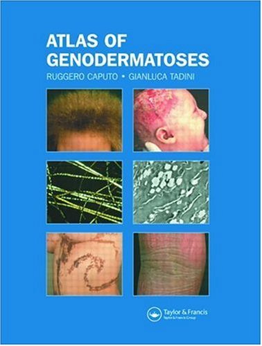 Atlas Of Genodermatoses 1st Edition Ruggero Caputo Gianluca Tadini