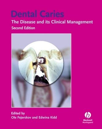 Dental Caries The Disease And Its Clinical Management 2ed Fejerskov O
