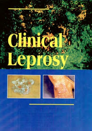 Histopathological Diagnosis of Leprosy 1st edition by Cleverson Teixeira Soares ISBN 1681088010 978-1681088013
