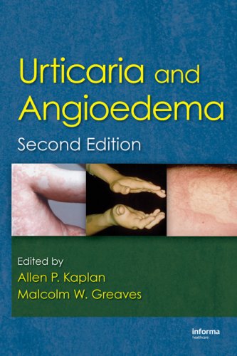Urticaria And Angioedema Second Edition 2nd Edition Allen Kaplan