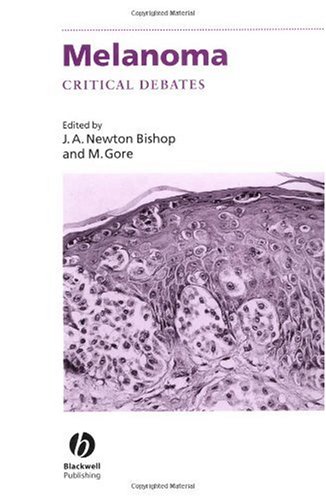 Melanoma Critical Debates Challenges In 1st Edition Julia A Newton Bishop