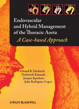 Endovascular And Hybrid Management Of The Thoracic Aorta A Casebased Approach 1st Edition Edward B Diethrich