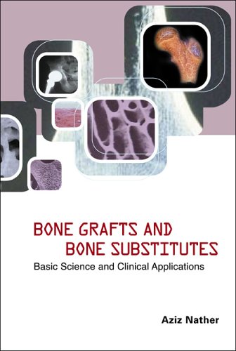 Bone Grafts And Bone Substitutes Basic Science And Clinical Applications Aziz Nather