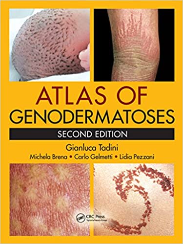 Atlas Of Genodermatoses 2nd Edition 2nd Edition Gianluca Tadini
