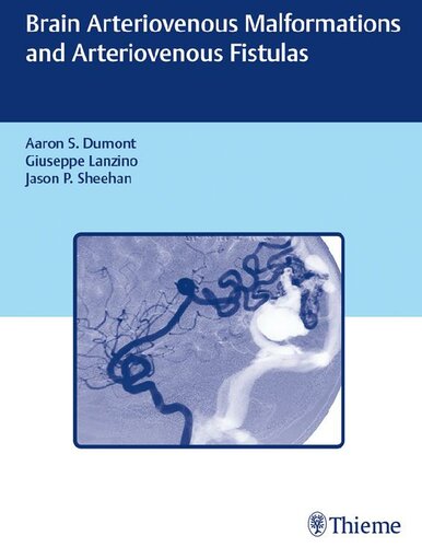 Brain Arteriovenous Malformations And Arteriovenous Fistulas Jason P Sheehan