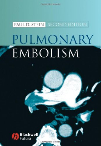 Pulmonary Embolism 2nd Edition Paul Stein