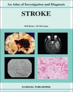 Ischemic Stroke An Atlas Of Investigation And Treatment Atlases Of Investigation And Management 1st Edition Isaac E