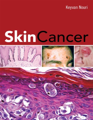 Skin Cancer Keyvan Nouri