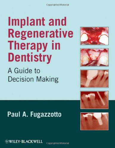 Implant And Regenerative Therapy In Dentistry A Guide To Decision Making 1st Edition Paul A Fugazzotto