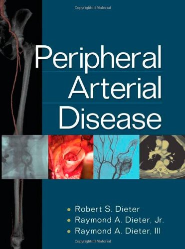 Peripheral Arterial Disease 1st Edition Robert Dieter Iii Raymond Dieter