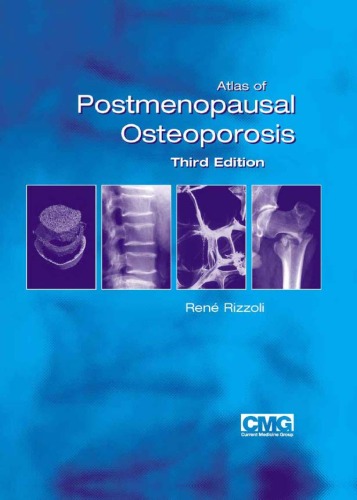 Atlas Of Postmenopausal Osteoporosis 3rd Edition 3rd René Rizzoli