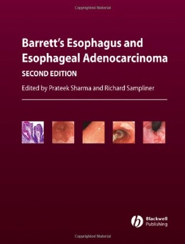 Barretts Esophagus And Esophageal Adenocarcinoma Second Edition 2nd Prateek Sharma