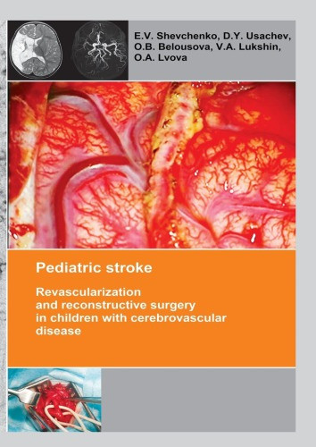 Pediatric Stroke Revascularization And Reconstructive Surgery In Children With Cerebrovascular Disease Belousova