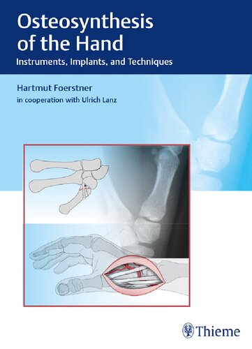 Osteosynthesis Of The Hand Instruments Implants And Techniques 1st Edition Hartmut Foerstner