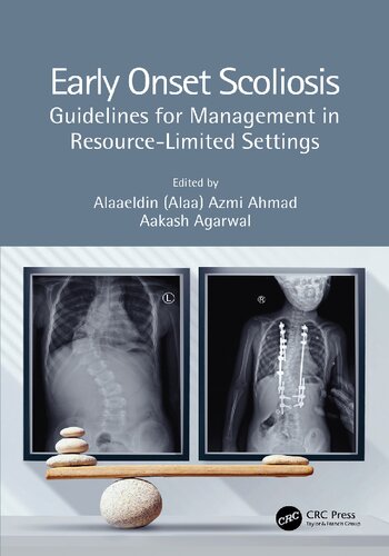 Early Onset Scoliosis Guidelines For Management In Resourcelimited Settings Aakash Agarwal