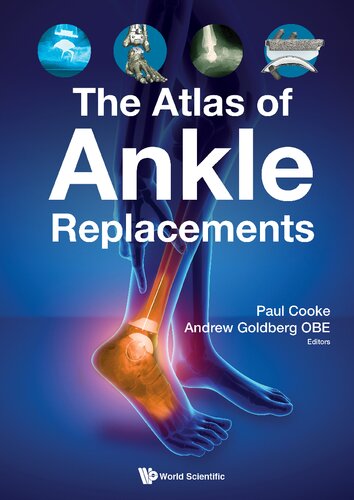 The Atlas Of Ankle Replacements Andrew Goldberg Paul Cooke