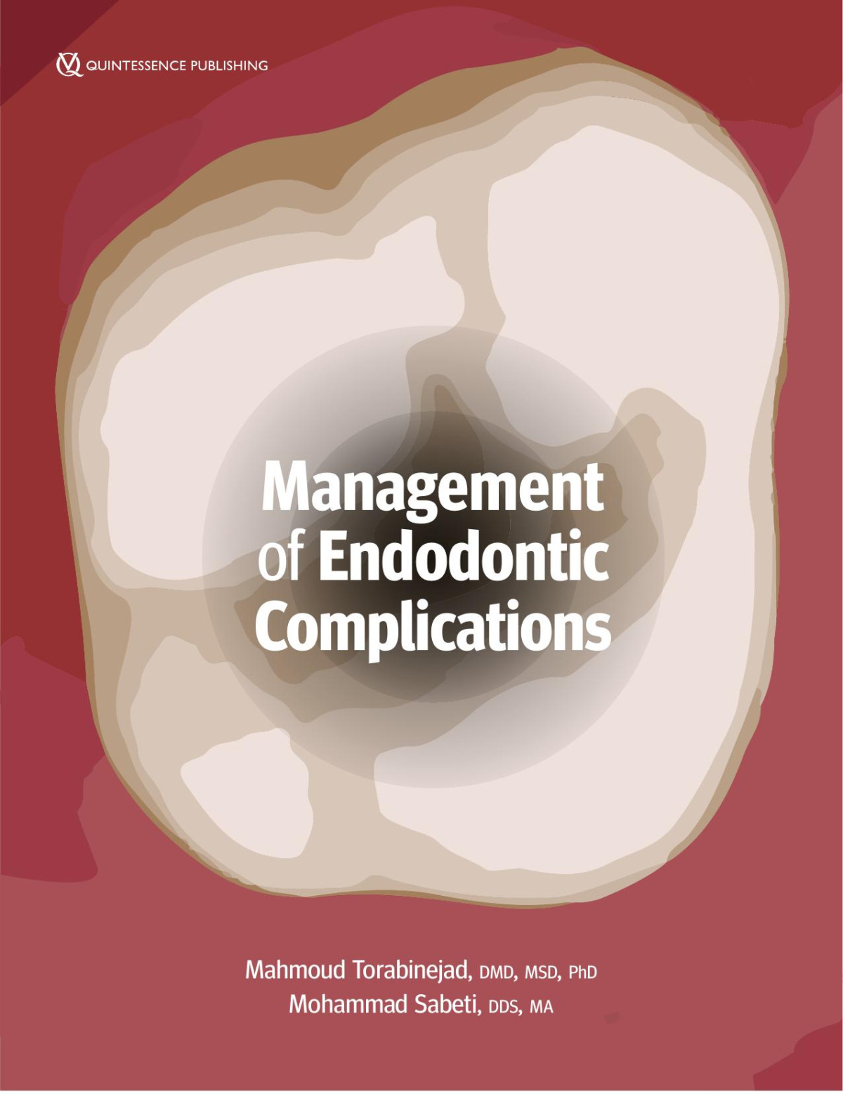 Management Of Endodontic Complications Mahmoud Torabinejad Mohammad Sabeti 2023 288 Pp Isbn 9781647240523 Mahmoud Torabinejad