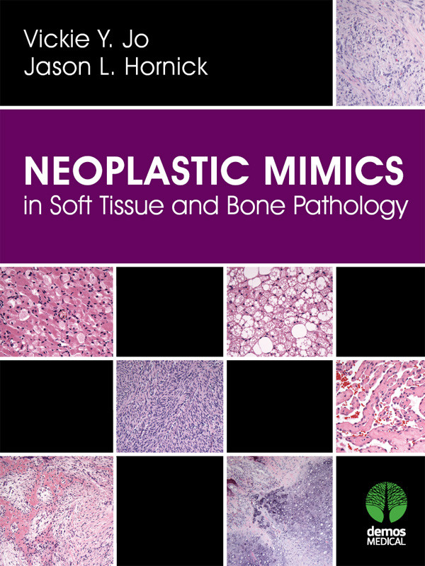Neoplastic Mimics In Soft Tissue And Bone Pathology Jason L Hornick