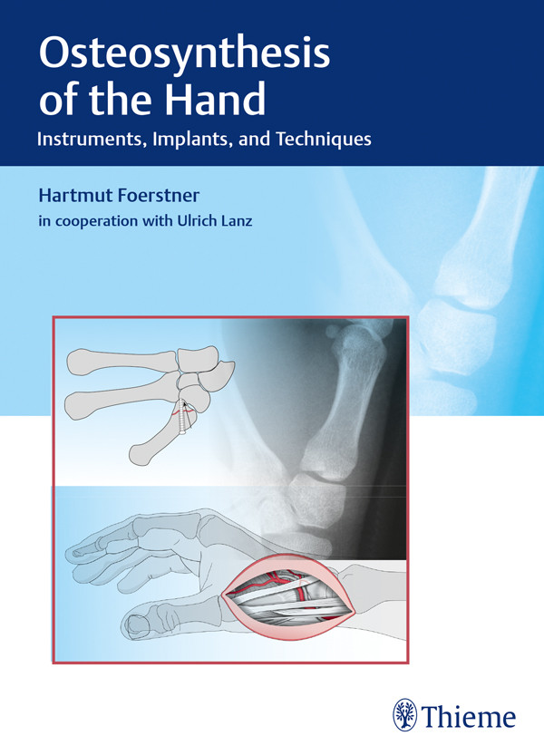 Osteosynthesis Of The Hand Hartmut Forstner