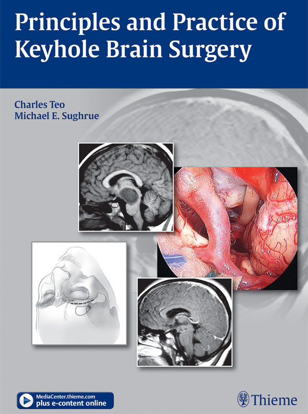 Principles And Practice Of Keyhole Brain Surgery Teo Charles