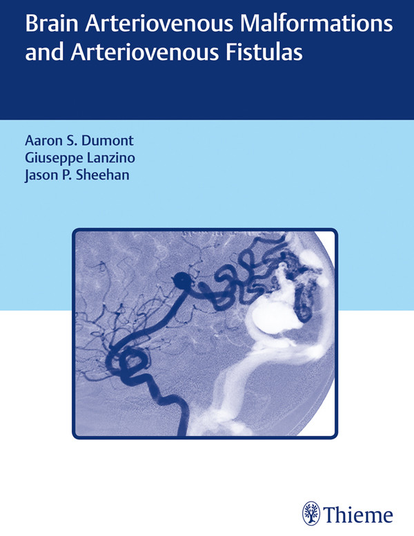 Brain Arteriovenous Malformations And Arteriovenous Fistulas Aaron S Dumont