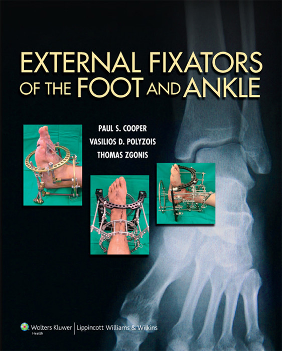 External Fixators Of The Foot And Ankle Cooper Paulzgonis Thomaspolyzois