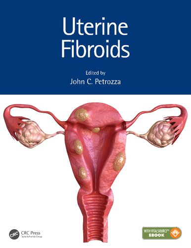 Uterine Fibroids John C Petrozza