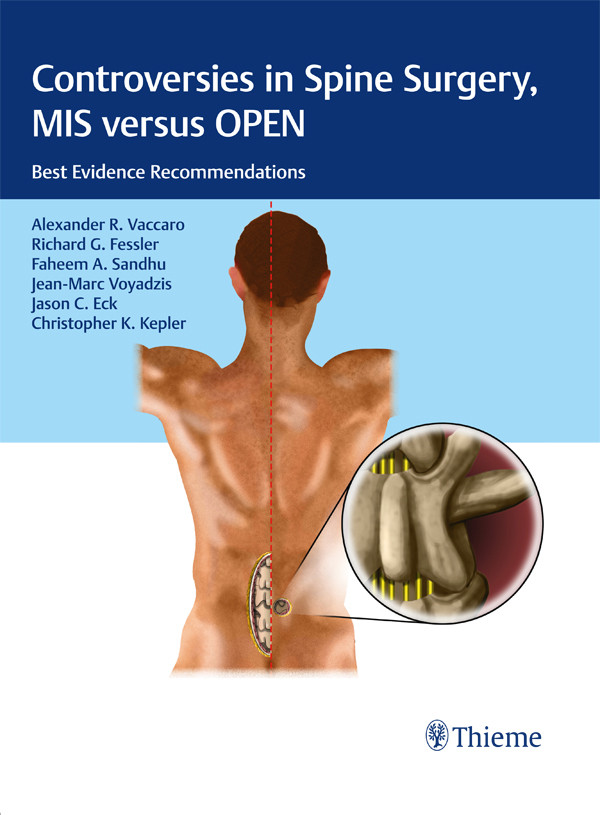 Controversies In Spine Surgery Mis Versus Open Alexander R Vaccaro