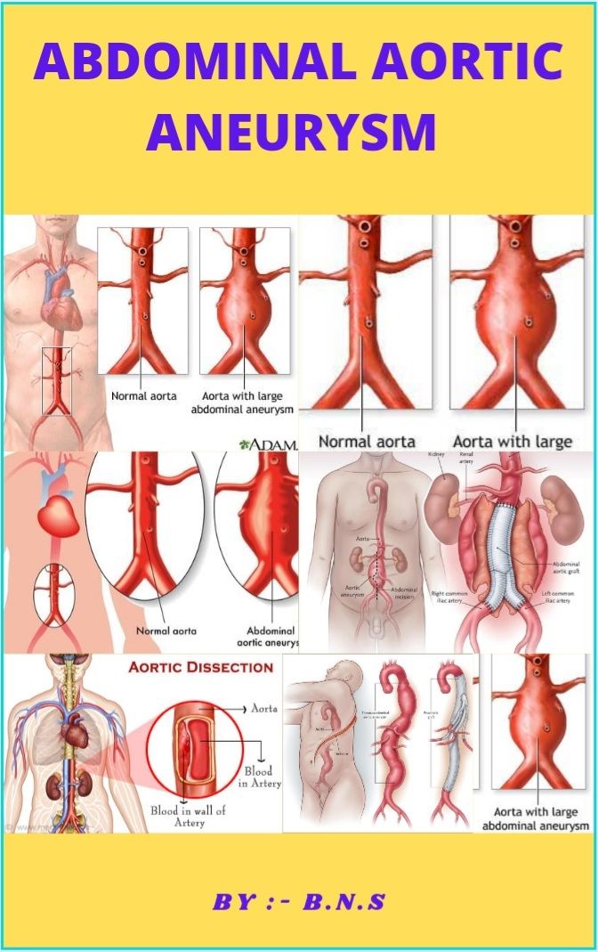 Abdominal Aortic Aneurysm Sharma Bidyanand Sharma Bidyanand
