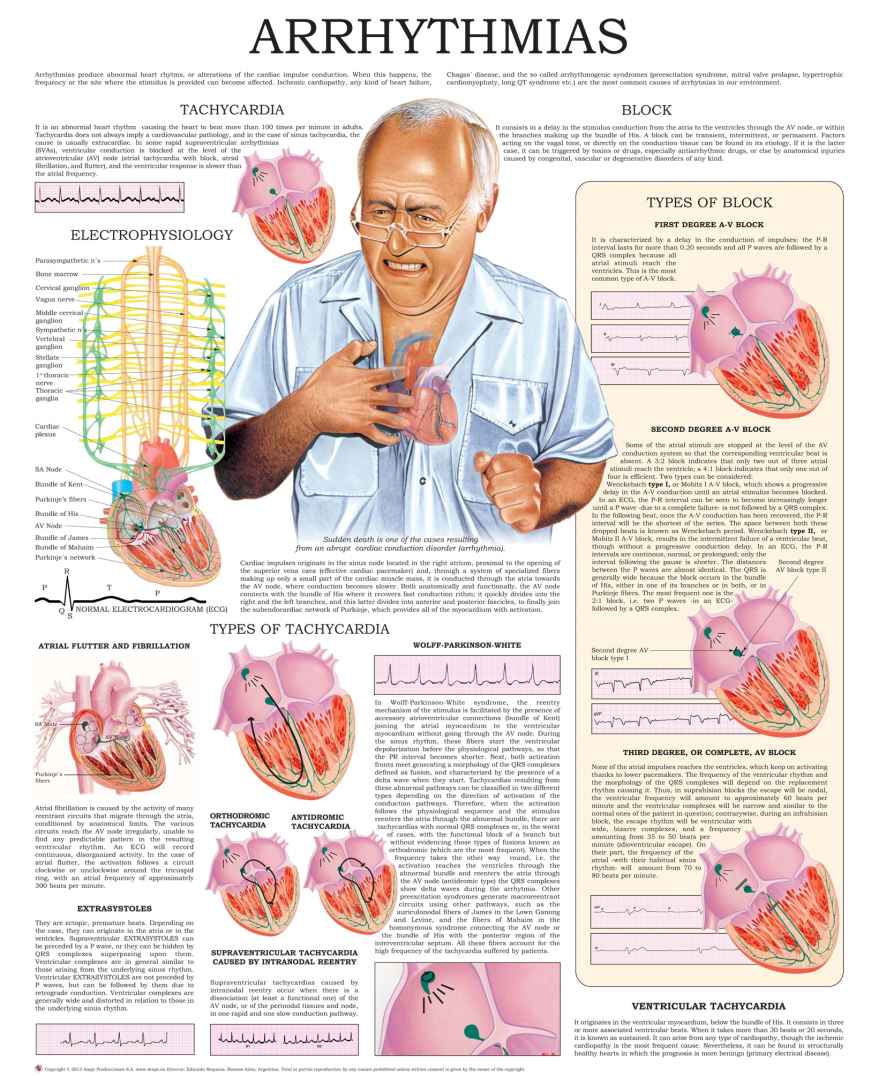 Arrhythmias Echart Hchealthcomm