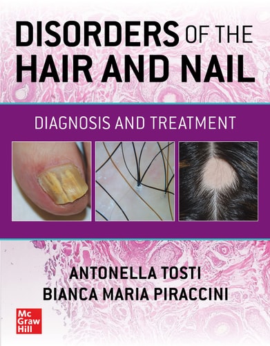 Disorders Of The Hair And Nail Diagnosis And Treatment Sep 18 20231260462471mcgraw Hillpdf 1st Edition Antonella Tosti