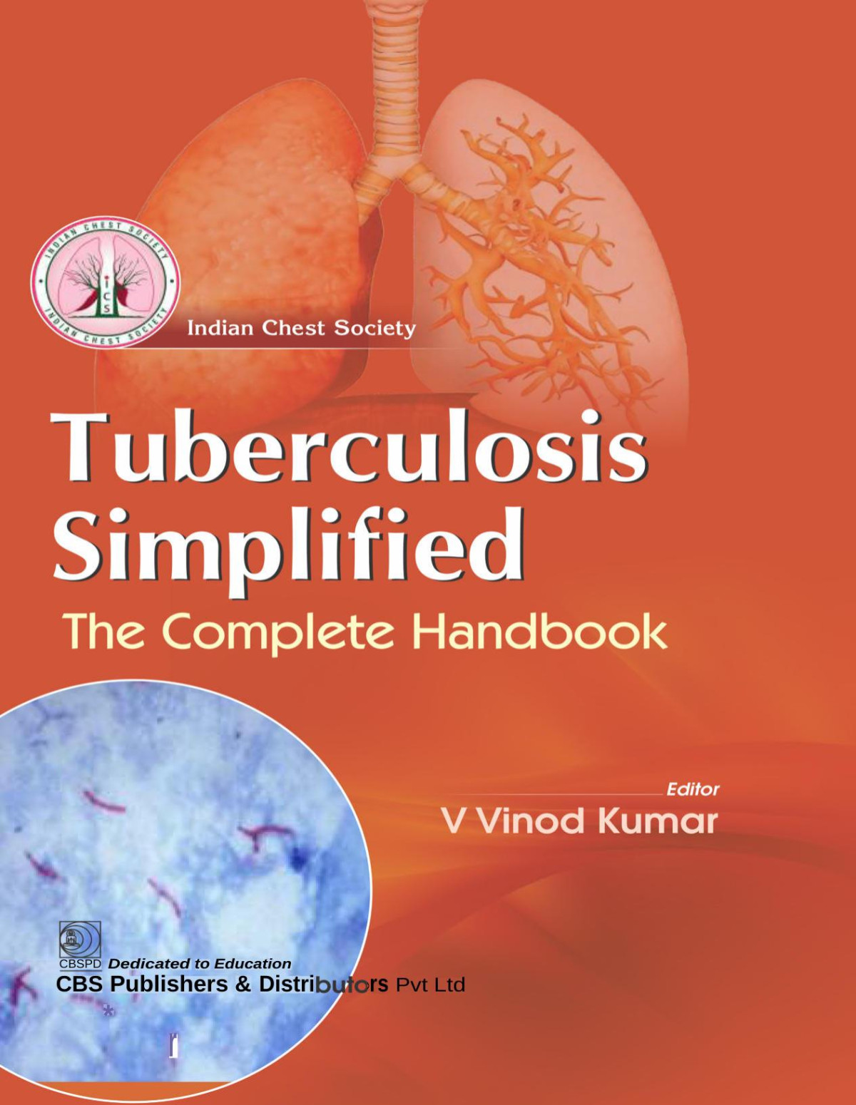 Tuberculosis Simplified The Complete Handbook May 9 20249354669859cbs Publishers And Distributors Pvt Ltd V Vinod Kumar