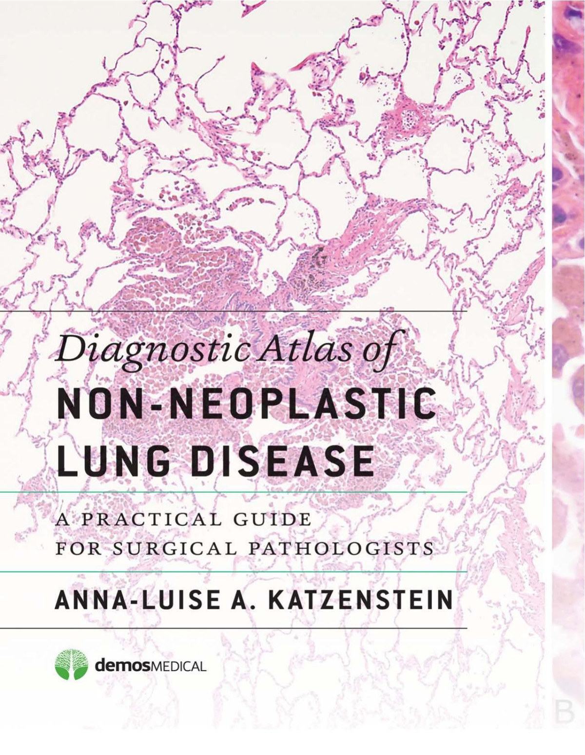 Diagnostic Atlas Of Nonneoplastic Lung Disease A Practical Guide For Surgical Pathologists 1st Annaluise A Katzenstein