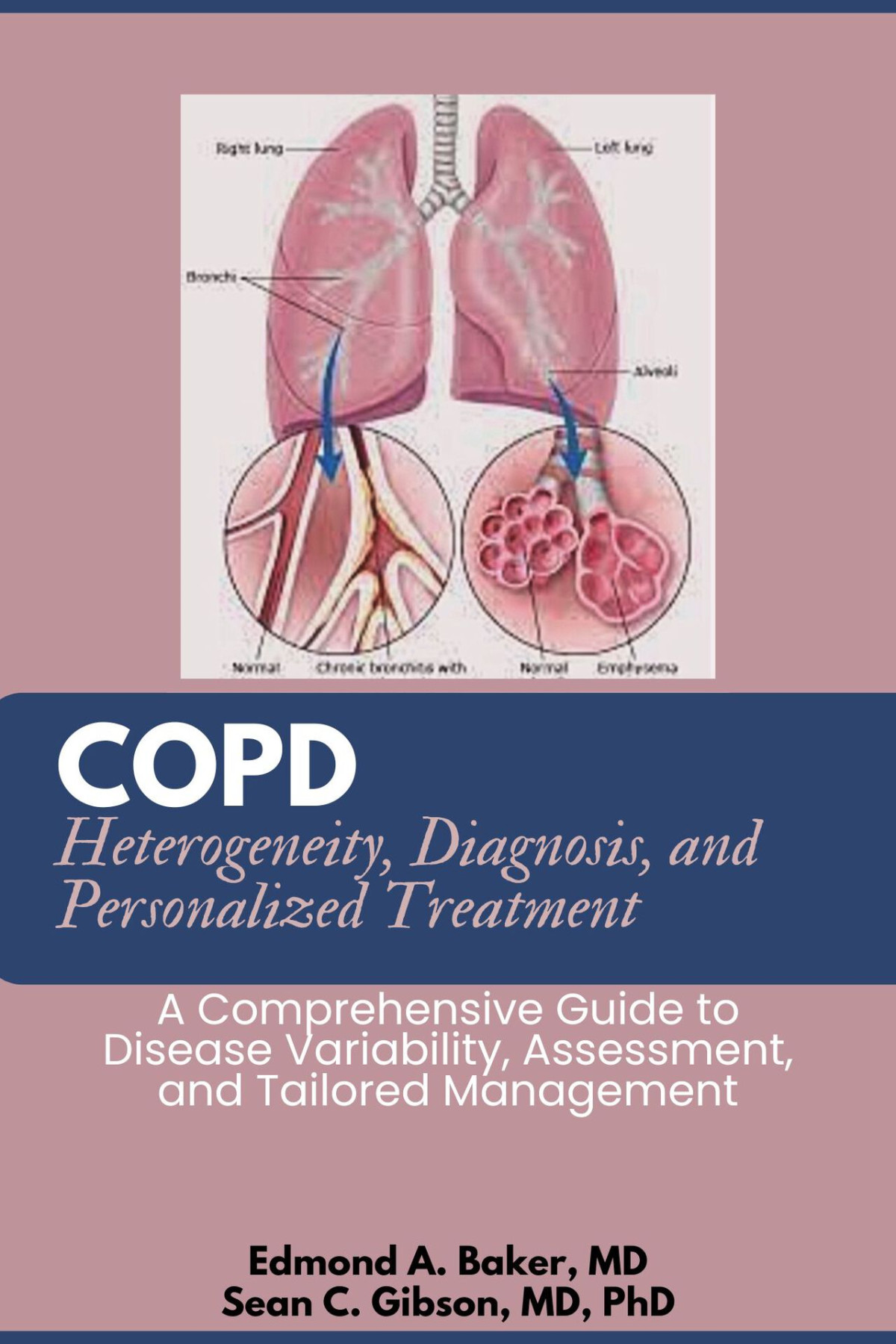 Copd Heterogeneity Diagnosis And Personalized Treatment A Comprehensive Guide To Disease Variability Assessment And Tailored Management Sean C Gibson