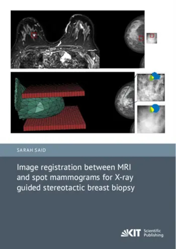 Image Registration Between Mri And Spot Mammograms For Xray Guided Stereotactic Breast Biopsy Sarah Said