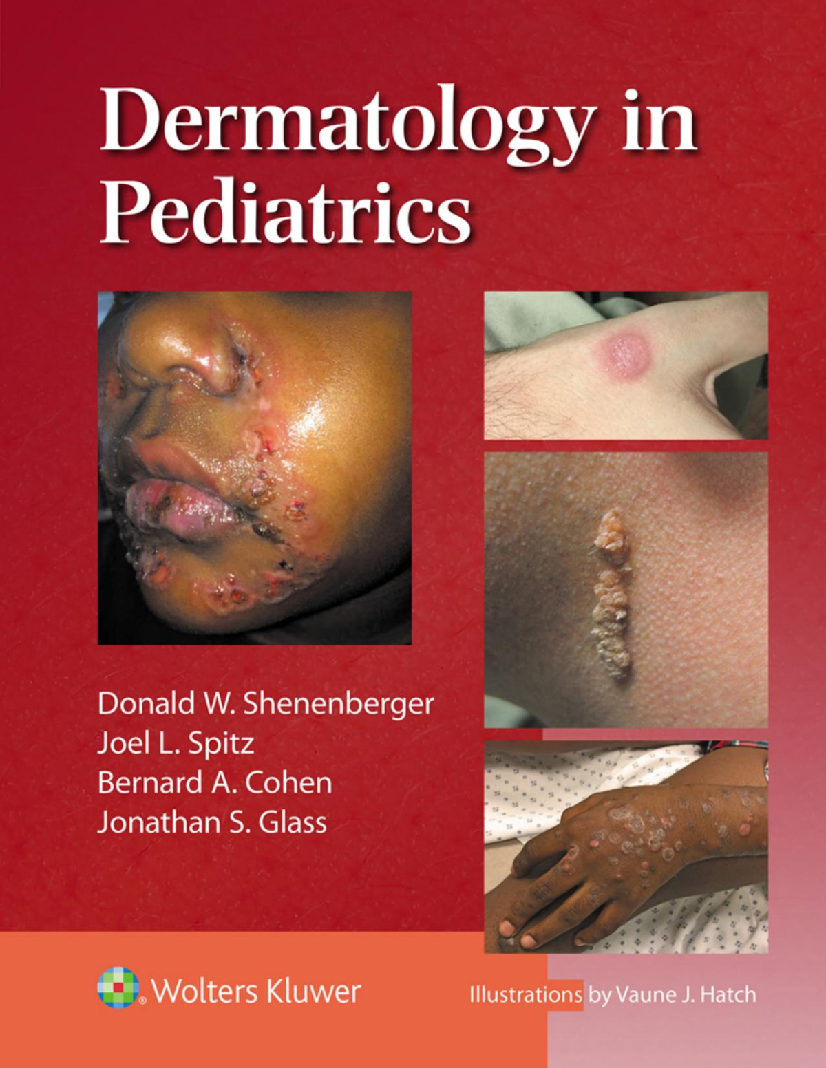Dermatology In Pediatrics Donald W Shenenberger Joel L Spitz