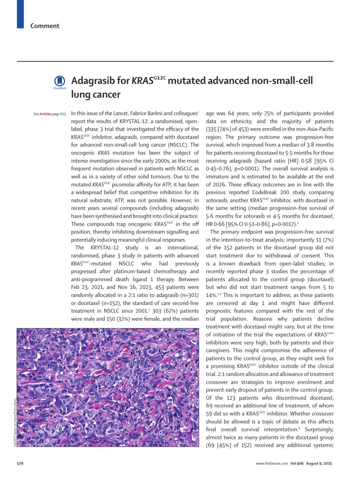 Adagrasib For Krasg12c Mutated Advanced Nonsmallcell Lung Cancer Egbert F Smit Annemarie C Dingemans