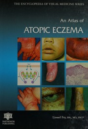 An Atlas Of Atopic Eczema Fry Lionel
