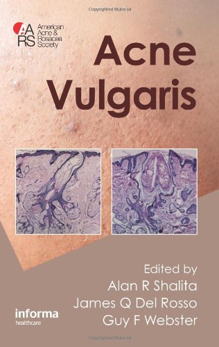 Acne Vulgaris 1st Edition Alan R Shalita James Q Del Rosso