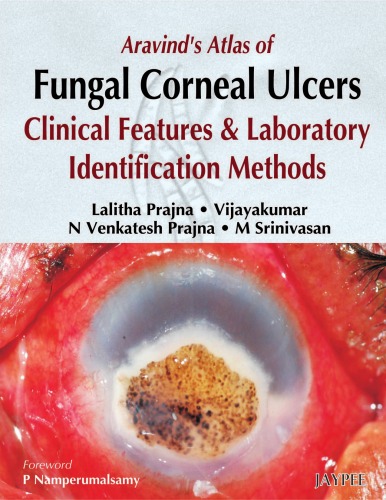 Aravinds Atlas Of Fungal Corneal Ulcers Clinical Features And Laboratory Identification Methods 1st Lalitha Prajna