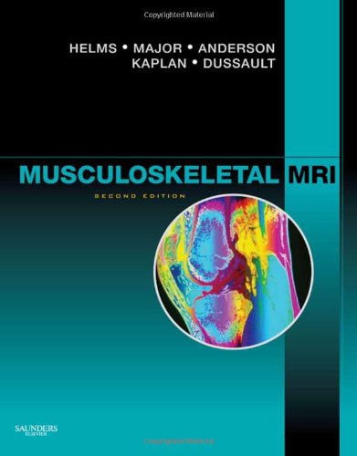 Musculoskeletal Mri 2nd Edition 2nd Edition Clyde A Helms Md