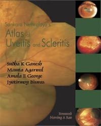 Atlas Of Uvetis And Scleritis First Edition Sudhak Ganesh Mamta Agarwal