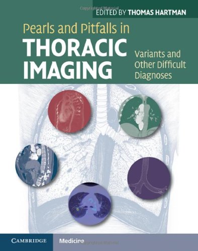 Pearls And Pitfalls In Thoracic Imaging Variants And Other Difficult Diagnoses 1st Edition Thomas Hartman