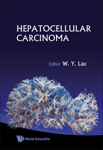 Hepatocellular Carcinoma 1st Edition W Y Lau