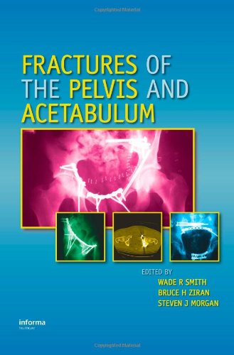 Fractures Of The Pelvis And Acetabulum 1st Edition Wade R Smith