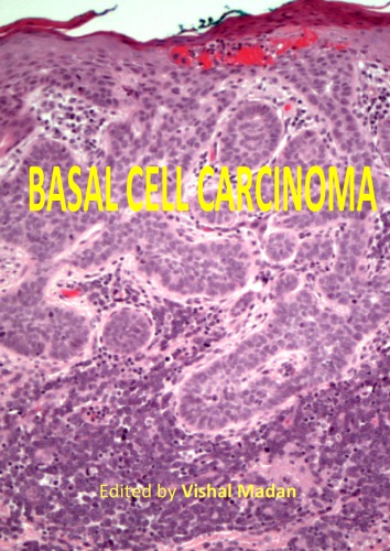 Basal Cell Carcinoma Vishal Madan