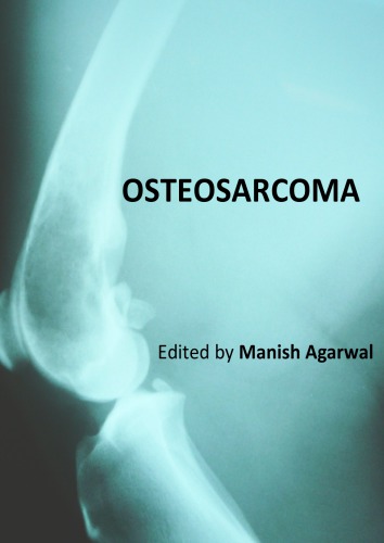 Osteosarcoma Manish Agarwal