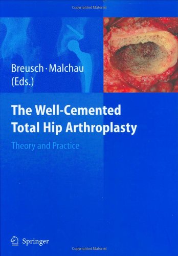 The Wellcemented Total Hip Arthroplasty Theory And Practice 1st Edition Steffen Breusch