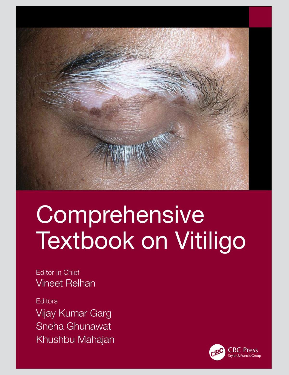 Comprehensive Textbook On Vitiligo Vineet Relhan Vijay Kumar Garg Sneha Ghunawat Khushbu Mahajan Vineet Relhan Vijay Kumar Garg Sneha Ghunawat Khushbu Mahajan