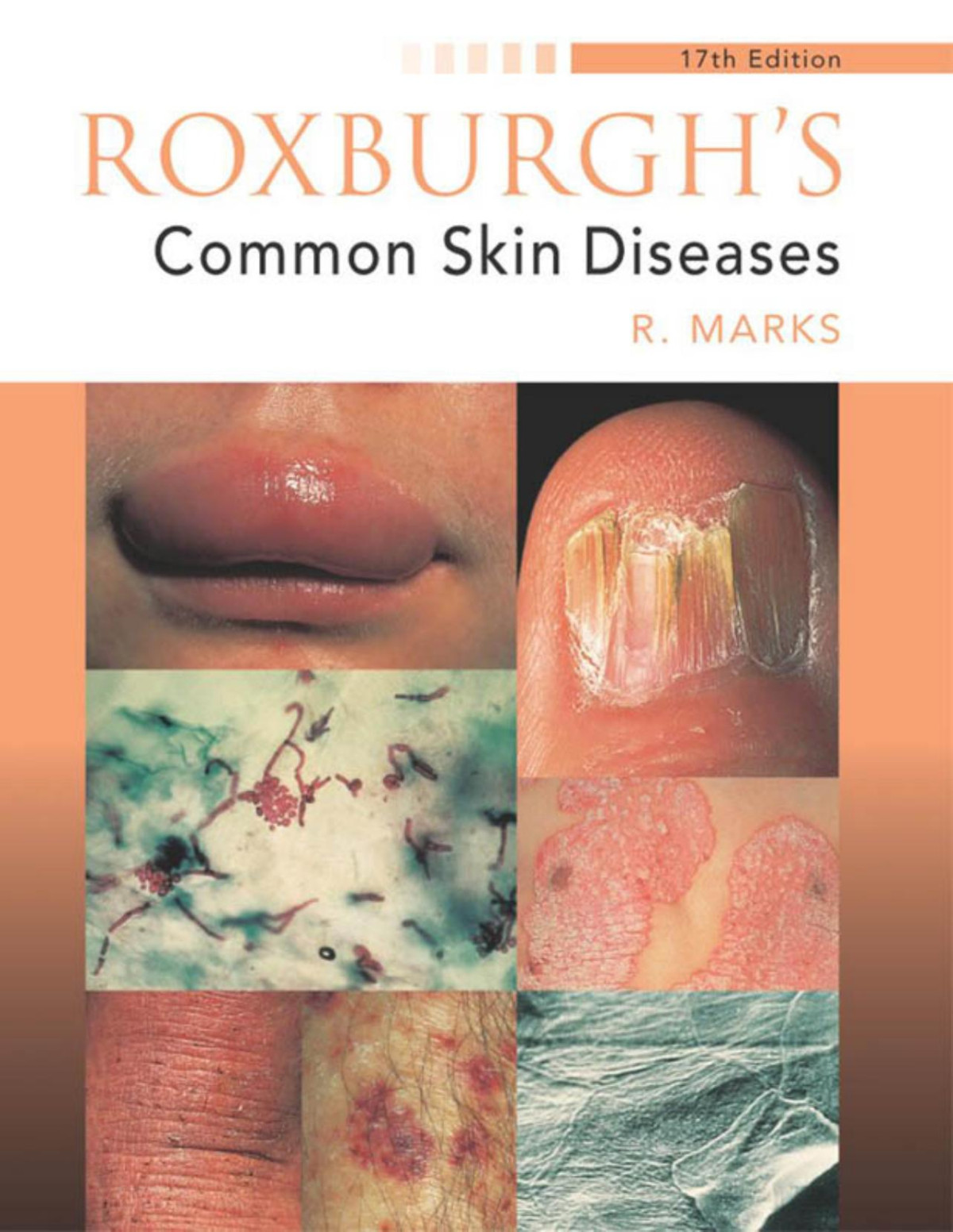 Roxburghs Common Skin Diseases 17th Marks R